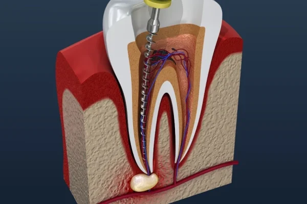 root canal treatment-078475-edited